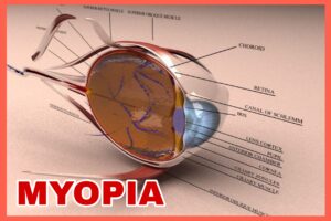 RETINOPATHY OF PREMATURITY AND MYOPIA